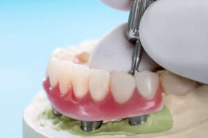 Implant Dentistry
