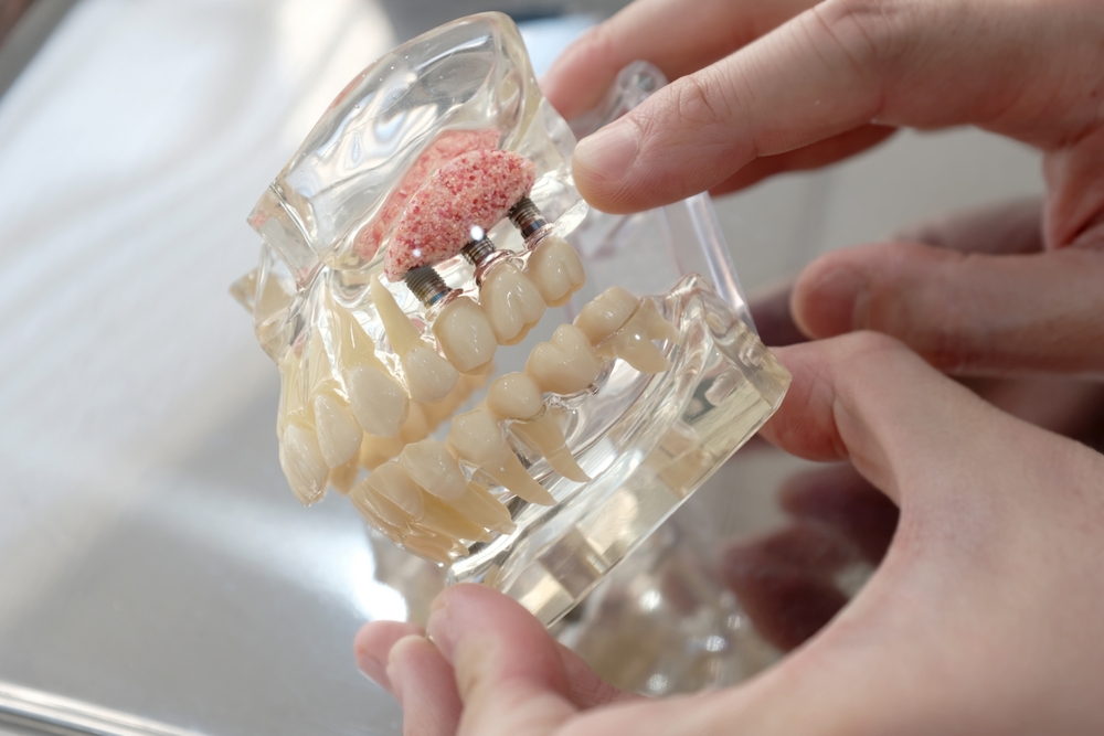 The 101 on Dental Bone Grafts