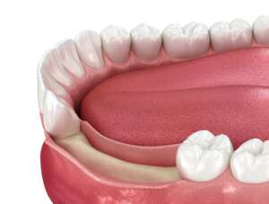 Bone grafting and socket preservation
