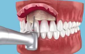 Crown Lengthening