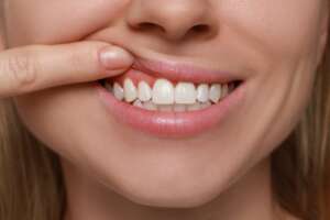 Gum Grafting